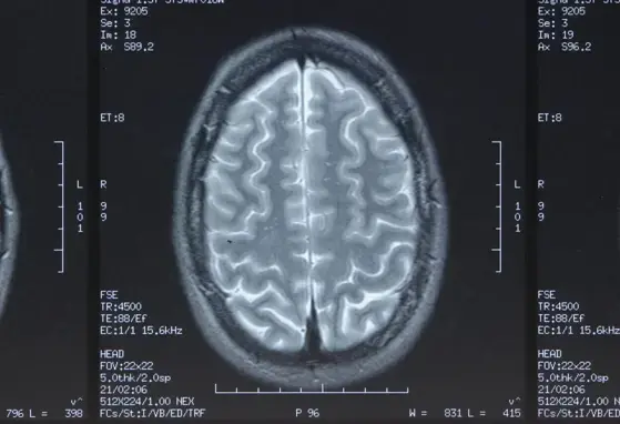 Tomografía computarizada de cerebro