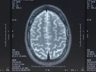 Tomografía computarizada de cerebro